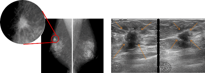 マンモグラフィ検査（左）と超音波検査（右）で発見された12mm径の乳がん