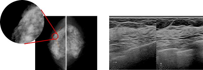 マンモグラフィ（左）の小さな石灰化で発見されたごく初期の乳がん（白い粒々が石灰化）、超音波検査（右）では描出されなかった
