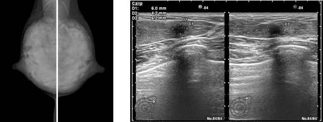 若年者（40歳前後）では乳腺組織が多く、マンモグラフィでは腫瘍が見えない（左）が、超音波検査（右）で6mm径の乳がんが描出された