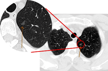 肺がんCT検診で発見されたごく初期の肺がん
