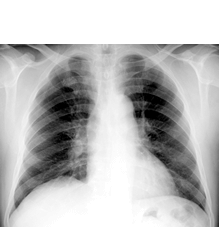 通常の胸部X線写真